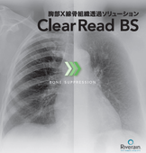 胸部X線骨組織透過処理システム『ClearRead BS』