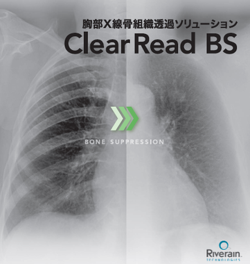 胸部X線骨組織透過処理システム 『ClearRead BS』 