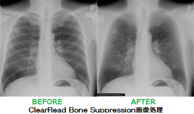 胸部X線骨組織透過処理システム 『ClearRead BS』 