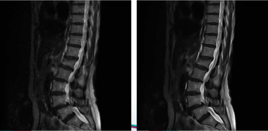 MRI装置用画質改善ソフトウェア・モジュール GOPView MRI2Plus 背骨