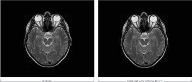 MRI装置用画質改善ソフトウェア・モジュール GOPView MRI2Plus 脳