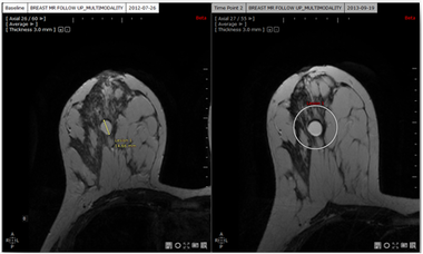 腫瘍 XL-Onco 弾性位置合わせ画像