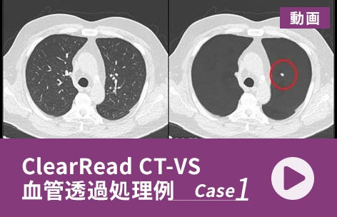 ClearRead CT-VS 血管透過処理例＜1＞