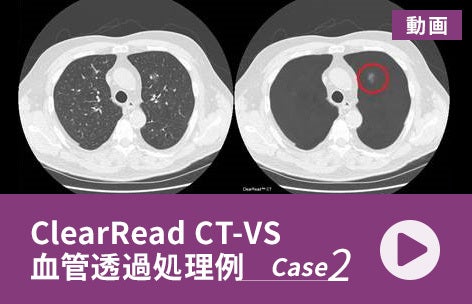 ClearRead CT-VS 血管透過処理例＜2＞