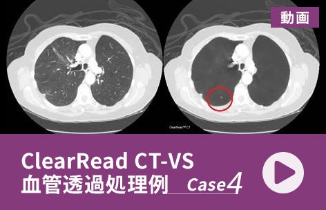 ClearRead CT-VS 血管透過処理例＜4＞