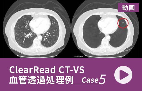 ClearRead CT-VS 血管透過処理例＜5＞