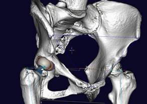 整形外科3Dデジタルプランニングツール 『mediCAD Hip 3D』 Hip3D 例1