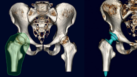 整形外科3Dデジタルプランニングツール 『mediCAD Hip 3D』 Hip3D 例2