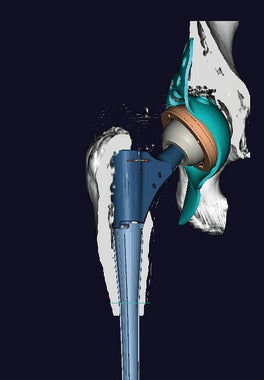 整形外科3Dデジタルプランニングツール 『mediCAD Hip 3D』 Hip3D 例5