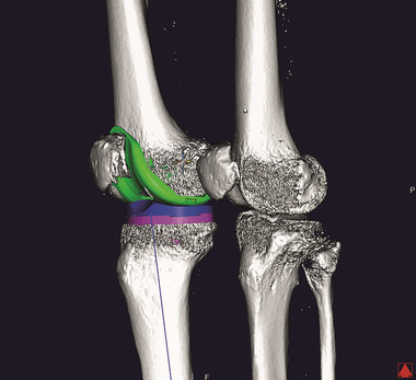 整形外科3Dデジタルプランニングツール 『mediCAD Knee 3D』 Knee3D 例1