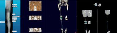 整形外科3Dデジタルプランニングツール 『mediCAD Knee 3D』 Hip3D 例3