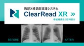 胸部X線読影支援システム　『ClearRead XR』