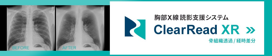 胸部X線読影支援システム ClearRead XR