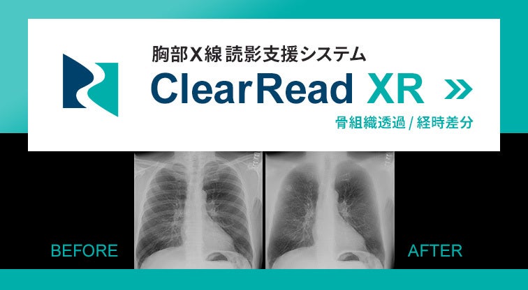 胸部X線読影支援システム ClearRead XR