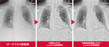 胸部X線医療用チューブ強調処理システム 『ClearRead +Confirm』 