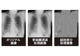 胸部X線骨組織透過／経時差分処理システム
