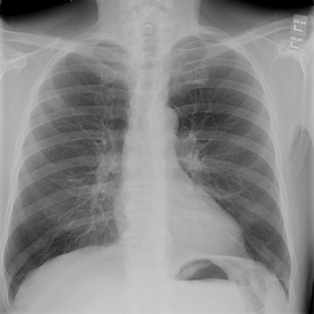   図1：胸部X 線画像例