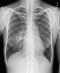 図4：胸部X 線現在画像例