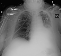 図7：ポータブルX 線撮影装置による胸部X 線画像例