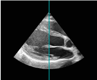 HEART%20valve%20image%20before%20and%20after.png